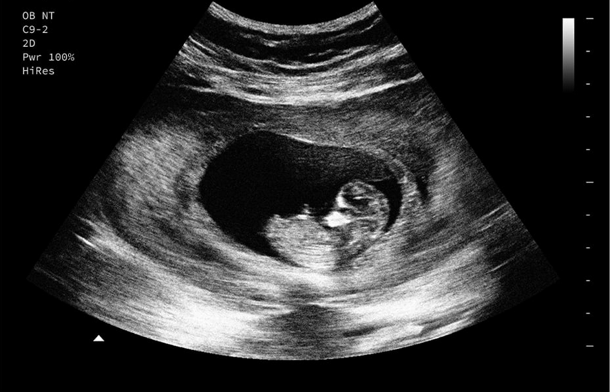 Personalized Fake Prank Pregnant Realistic Looking Black and White Ultrasound/Sonogram (