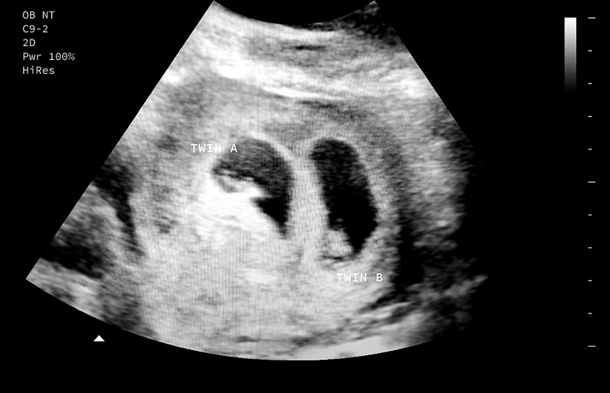 Personalized Fake Prank Pregnant Realistic Looking Black and White Ultrasound/Sonogram (Twin Babies)