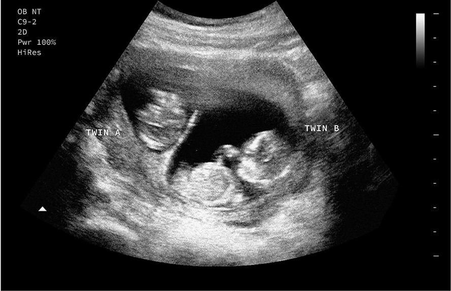 Personalized Fake Prank Pregnant Realistic Looking Black and White Ultrasound/Sonogram (Twin Babies)